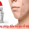 So sánh ưu và nhược điểm các phương pháp làm mờ sẹo rỗ phổ biến hiện nay
